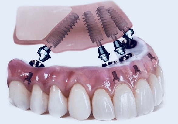 Dental Implants