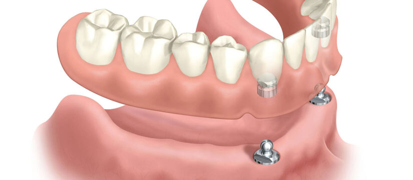 Denture Implants