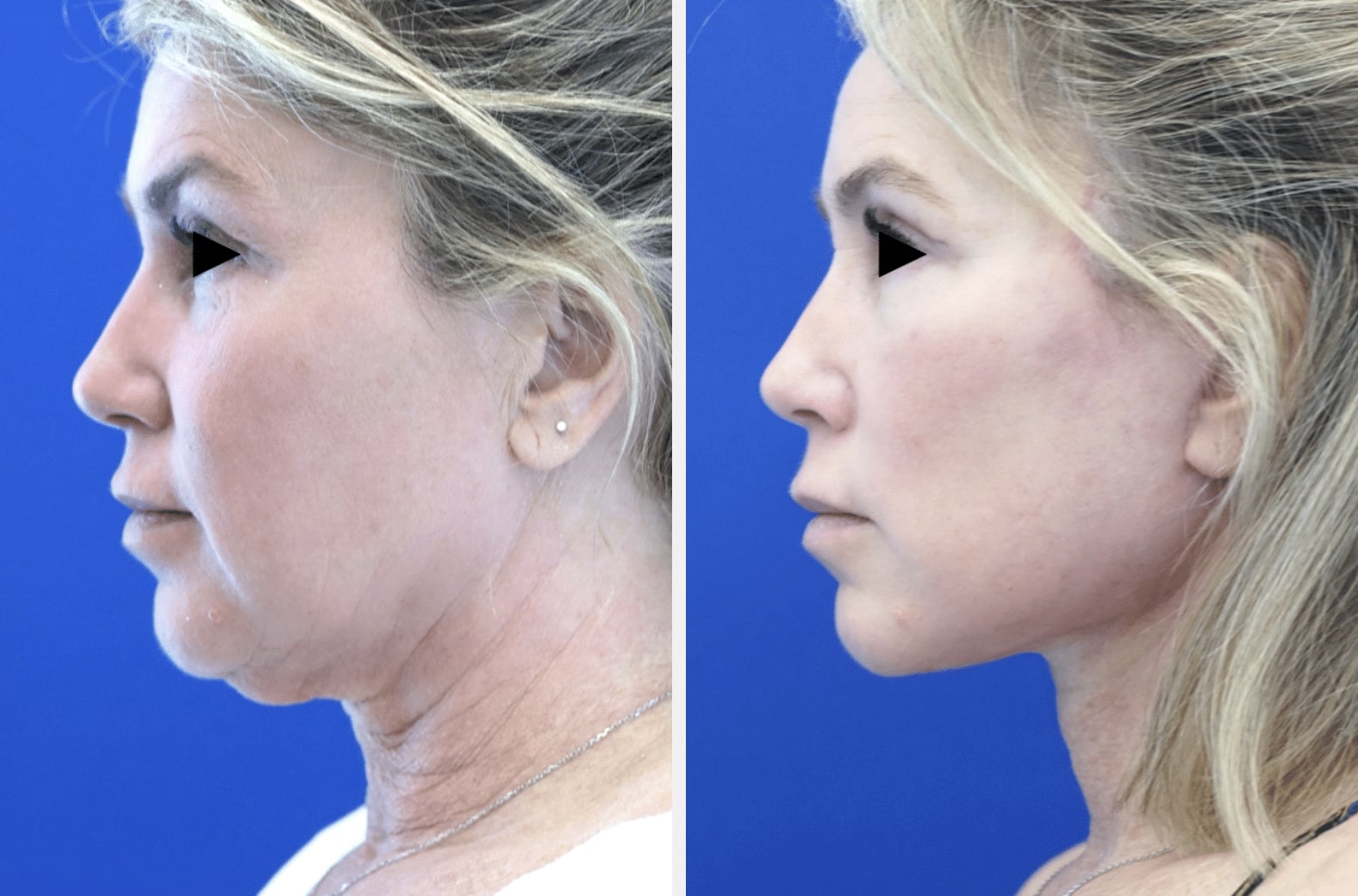 Facelift Scars